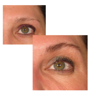 before afer browlift