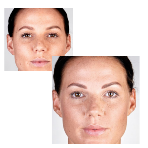 before afer browlift
